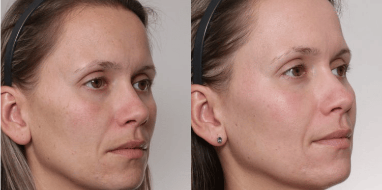 laser-skin-resurfacing-results-nashville-tn-gilpin What to Avoid After a Laser Skin Treatment Nashville, TN