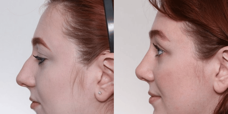 rhinoplasty-before-after-nashville-gilpin Can a Rhinoplasty Affect Your Singing Voice? Nashville, TN