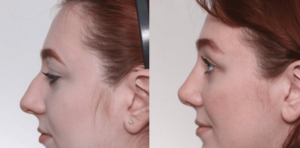 nose surgery nashville