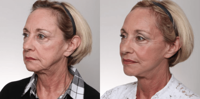 brentwood facelift results