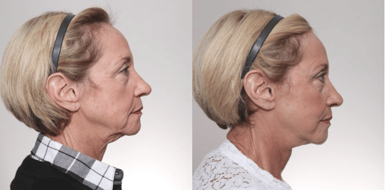 facelift results hendersonville