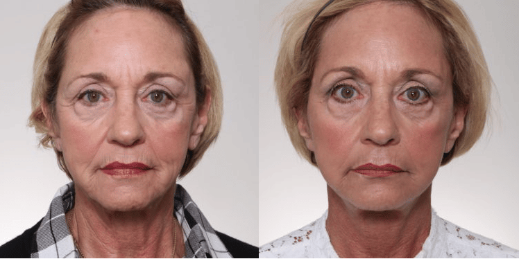 facelift results clarksville