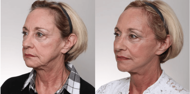 facelift before and after