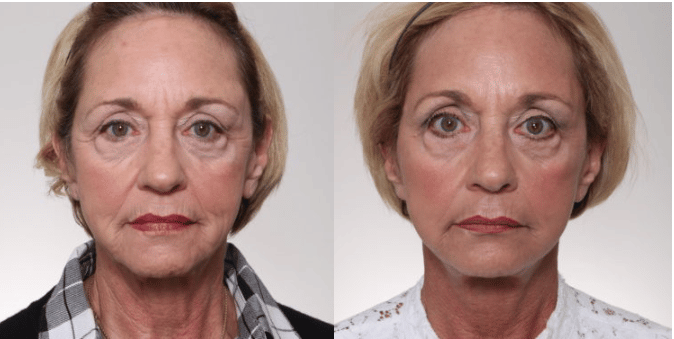 facelift results nashville