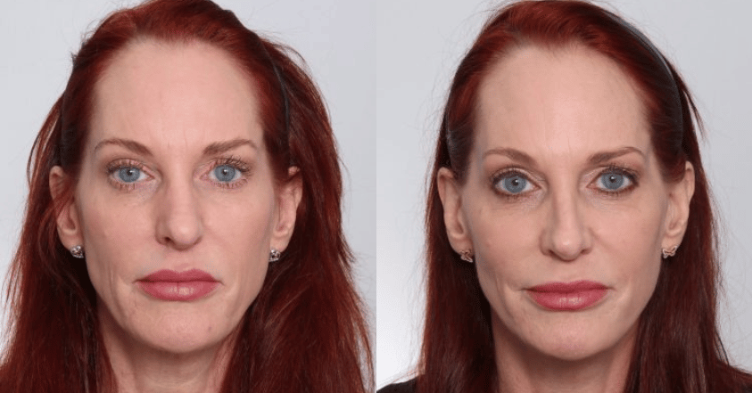 facelift brentwood results