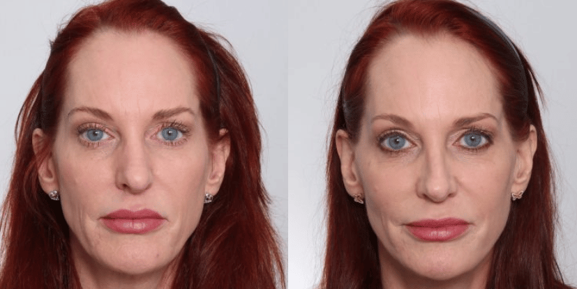 facelift before and after nashville