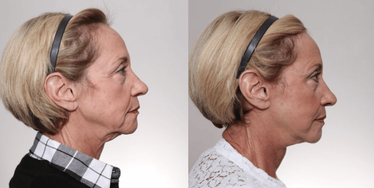 oak hill facelift results before and after