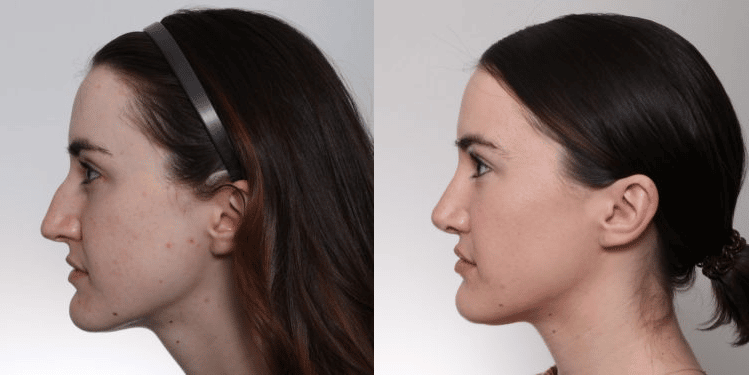 nose_job_rhinoplasty_gilpin_before_after_franklin_tn Facial Plastic Surgery in Franklin, TN Nashville, TN