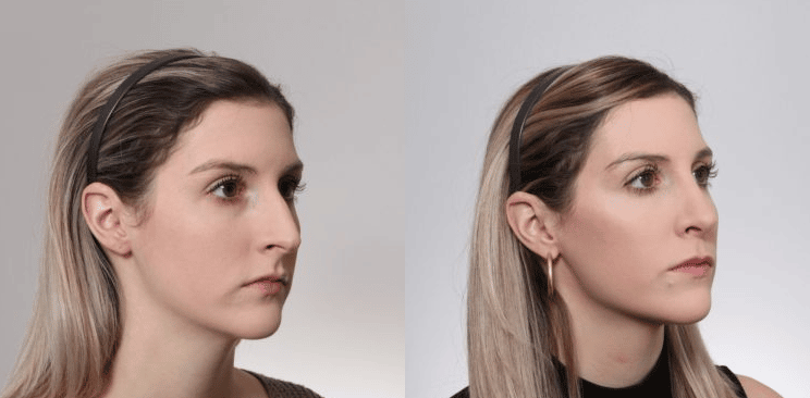 rhinoplasty-before-and-after-forest-hills-tn-gilpin-facial-plastics Facial Plastic Surgery in Forest Hills, TN Nashville, TN
