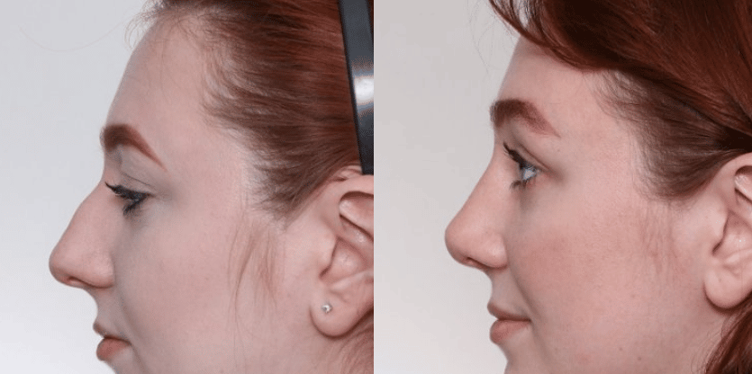 nose surgery before and after nashville
